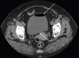 Figure 1 Abdominal CT with arrows demonstrating emphysematous changes in the bladder wall