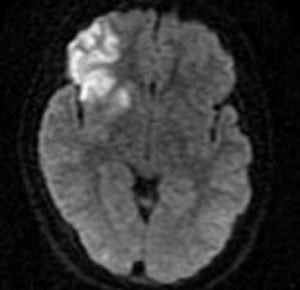 Figure Diffusion Weighted MRI consistent with a right frontal lobe and basal ganglia ischemic infarction