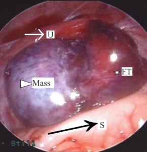 Figure 2 The torsed, ischemic left adnexa is seen between the sigmoid colon (black arrow/S) posteriorly and the uterus (white arrow/U) anteriorly. The fallopian tube (star/FT) is severely congested. The mass (triangle) has caused significant ovarian enlargement.