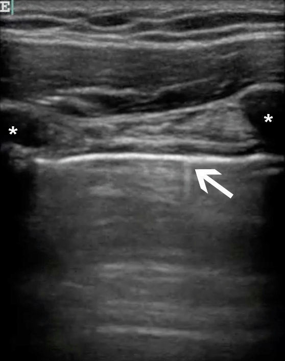 Clinician-performed Beside Ultrasound for the Diagnosis of Traumatic