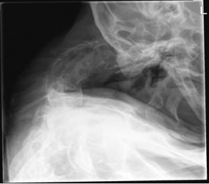 Figure. Acute cervical kyphosis with a fracture in a rigidly ankylosed cervical spine.