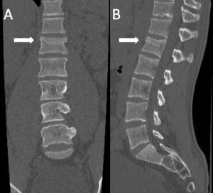 Figure 1. Chance fracture labeled A (antero-posterior view) and B (lateral view)involving body of the first lumbar vertebrae extending into the pedicle with probable pars interarticularis involvement without cord compression.