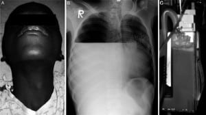 Figure 2. A, A 17-year-old male referred from the tuberculosis (TB) clinic for shortness of breath with evidence of tracheal deviation on examination of neck. B, Chest radiograph of 17-year-old male referred from TB clinic for shortness of breath reveals right-sided air-fluid level with pneumothorax and mediastinal shift. C, Purulent drainage from tube thoracostomy of patient with presumed TB effusion and pneumothorax. (All patient images taken with permission of patient or accompanying guardian.).