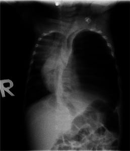 Figure 3. Chest radiograph of 3-month-old infant with shortness of breath reveals presumed tuberculosis-related pneumothorax and resultant mediastinal shift. (All patient images taken with permission of patient or accompanying guardian.)