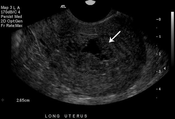 The tissue from Case 1, open and showing blood clots and endometrium