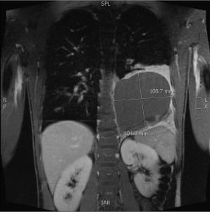 Figure. Chest magnetic resonance angiogram with contrast showing the extralobular pulmonary sequestration as a cystic lesion in the right lower lung field.