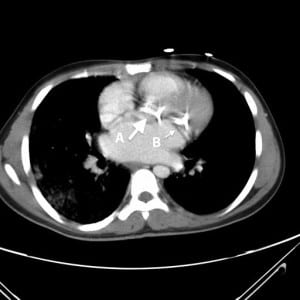Figure. Intravenous contrast enhanced computed tomography of the chest showing severe calcifications (arrows) of both aortic (A) and mitral (B) valves.