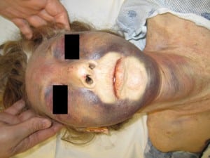 Figure. Patient with facial cyanosis and edema with cutaneous petechiae, subconjuctival hemmorhages, and echymosis across the anterior neck.
