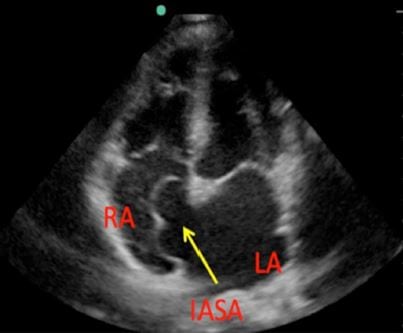 Figure Four-chamber apical view demonstrating a large interatrial septal aneurysm.<br /><br /><br /><br />
RA, right atrium; IASA, interatrial septal aneurysm; LA, left atrium