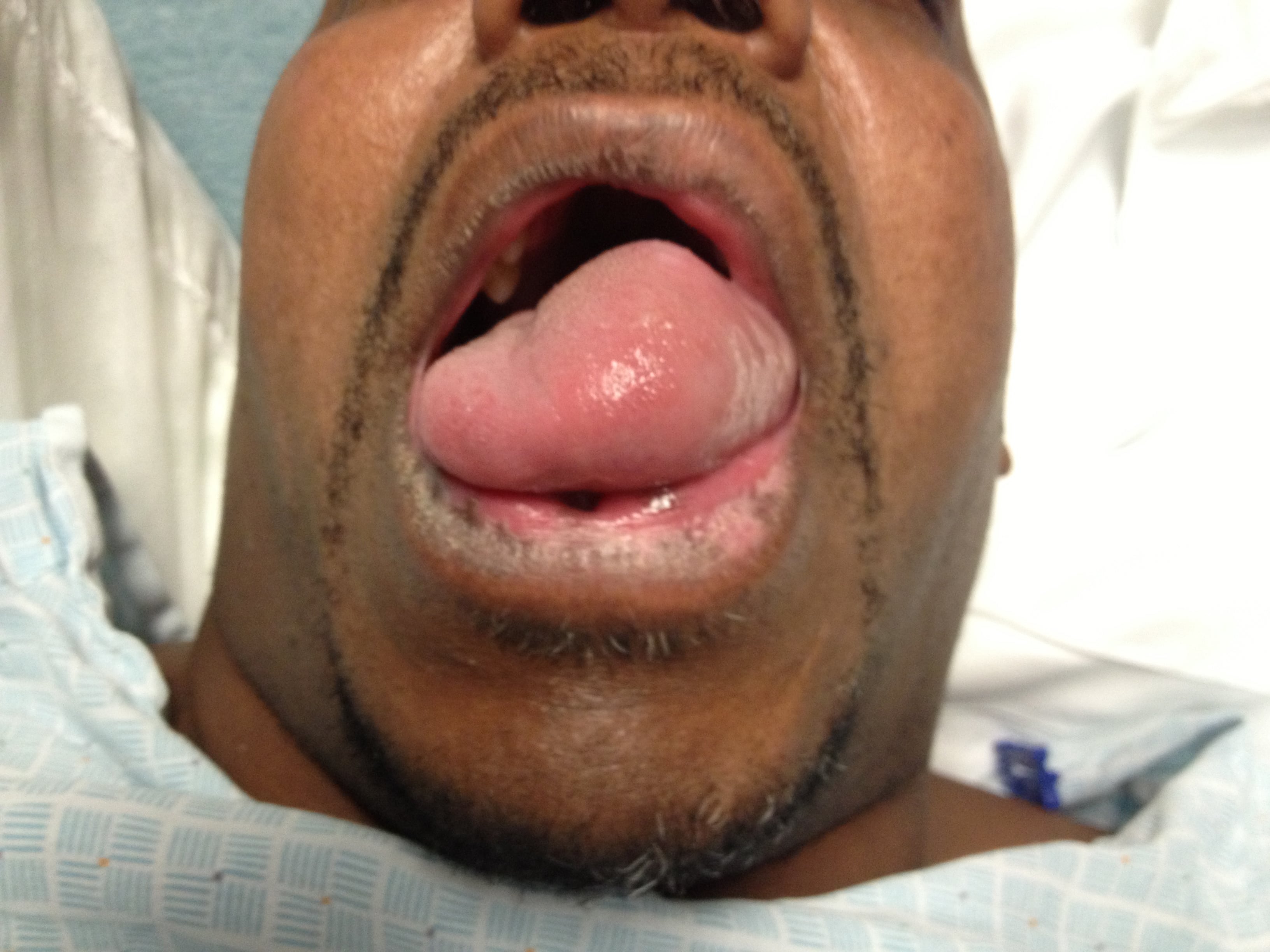 angioedema tongue