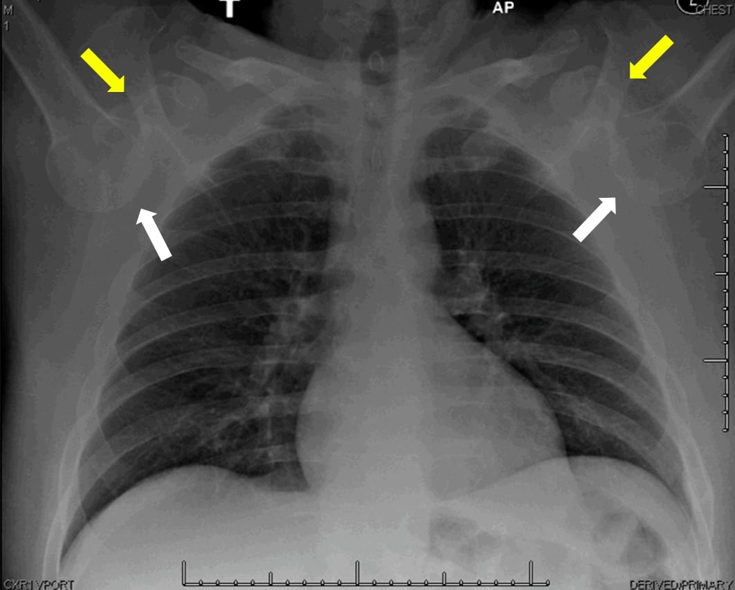 xray shoulder dislocation