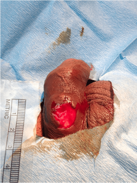 Penile Foreskin Avulsion from Parrot Fish Bite - The Western Journal of  Emergency Medicine