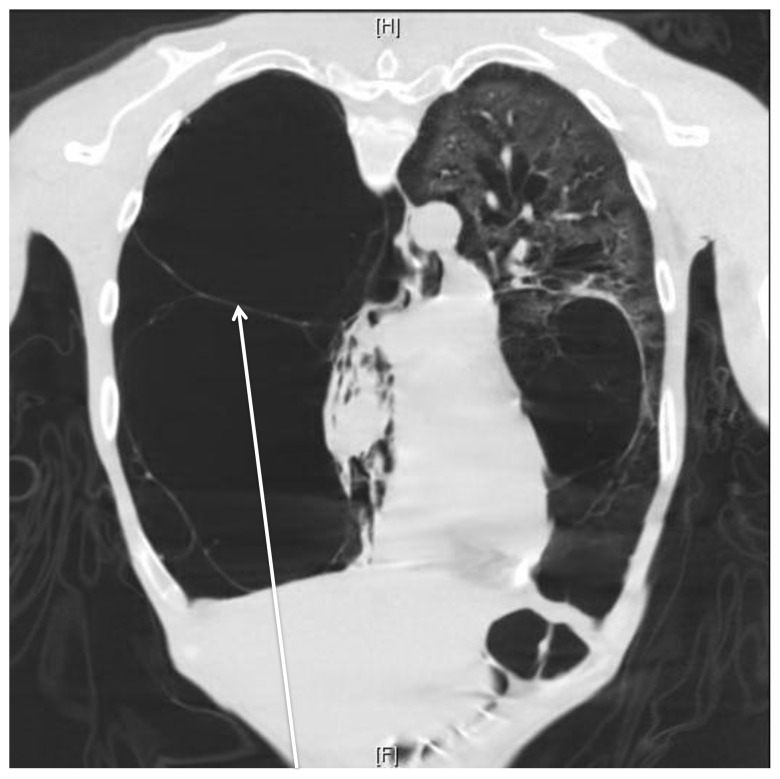 pulmonary bleb