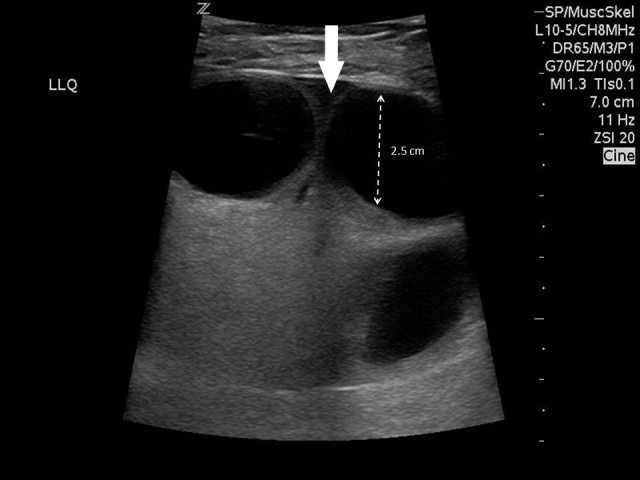 Diagnosis Of A Strangulated Laparoscopic Incisional Hernia With Point