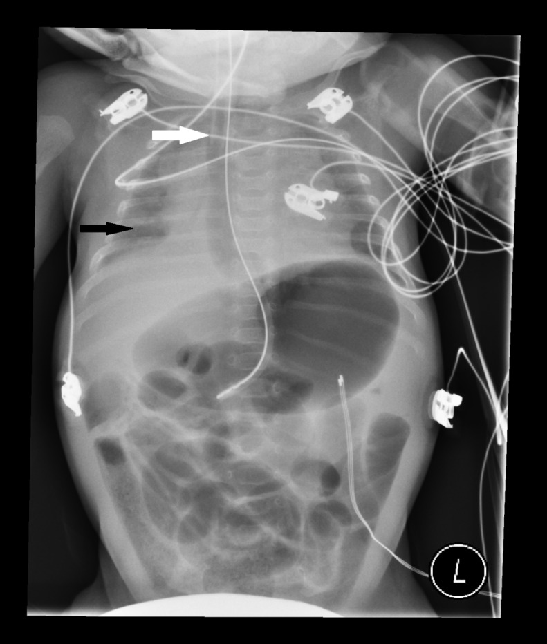 Esophageal Intubation of an Infant The Western Journal of Emergency