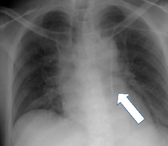 picc in innominate vein