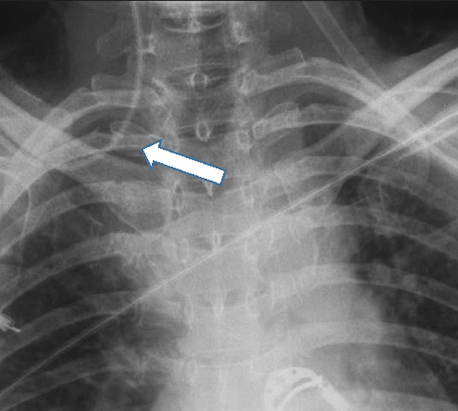 picc in innominate vein