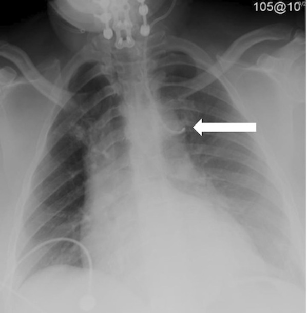 picc in innominate vein