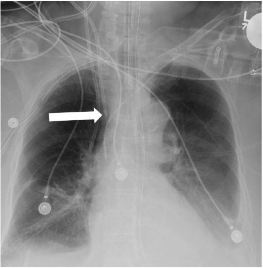 Central Venous Catheter Intravascular Malpositioning Causes