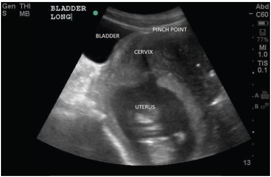 Stranded under the Prom: impacted gravid uterus presenting as acute urinary  retention