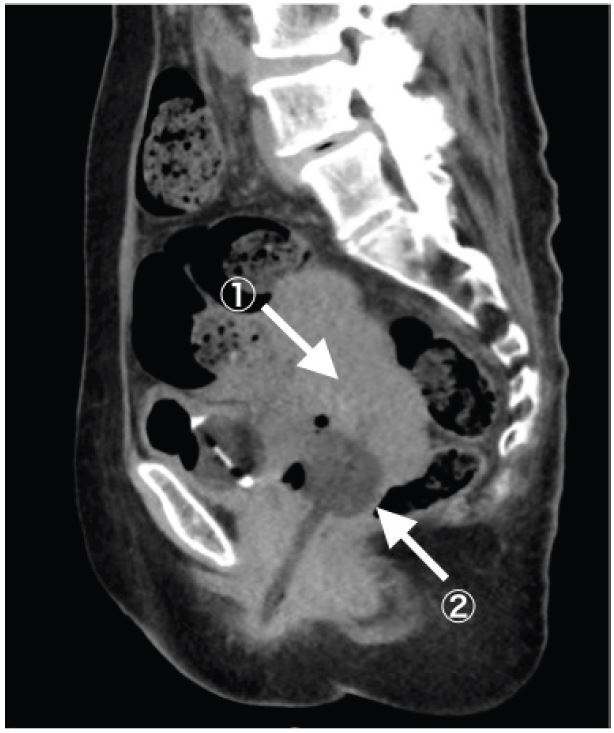 Uterine Incarceration: Rare Cause of Urinary Retention in Healthy Pregnant  Patients - The Western Journal of Emergency Medicine