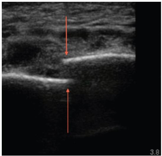 Ultrasound of Sternal Fracture The Western Journal of Emergency Medicine