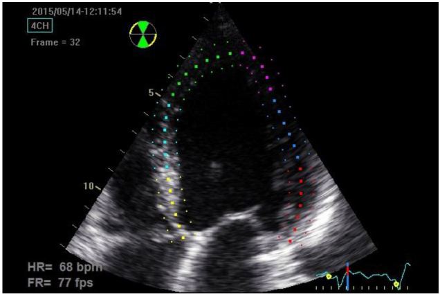 Strain Echocardiography in Acute Cardiovascular Diseases - The