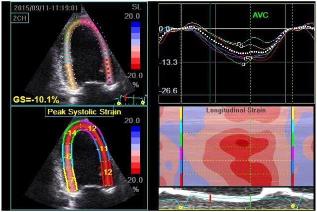 Segmental Speckle Tracking longitudinal strain analysis. Segmental