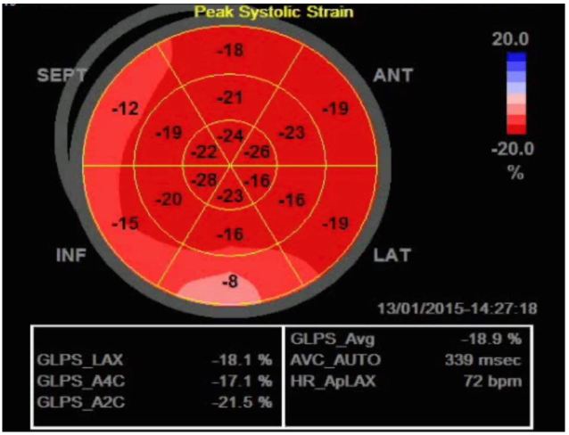 Strain Echocardiography in Acute Cardiovascular Diseases - The Western  Journal of Emergency Medicine