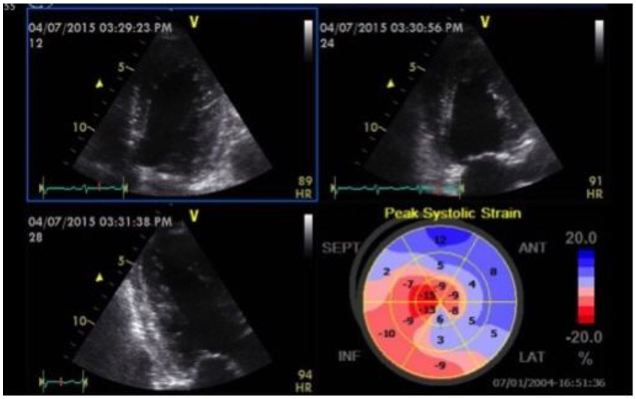 Strain Echocardiography in Acute Cardiovascular Diseases - The Western  Journal of Emergency Medicine