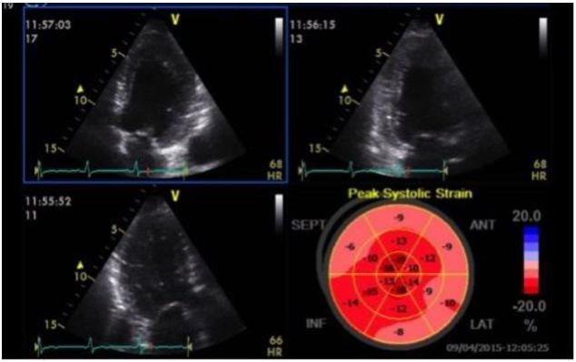 Global longitudinal strain: Bull's Eye Map. Global longitudinal