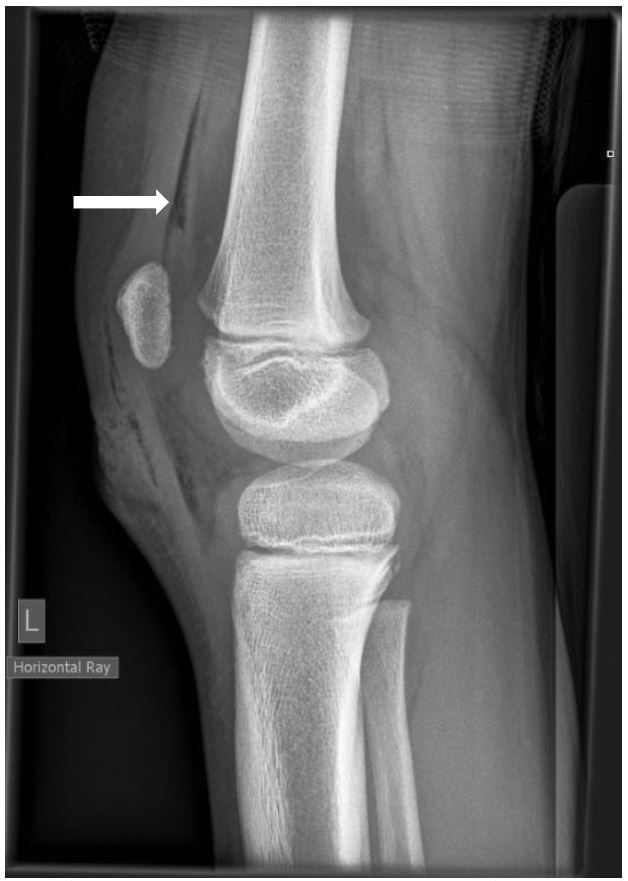 Traumatic Arthrotomy with Pneumarthrosis on Plain