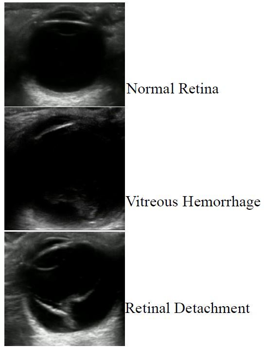 vitreous detachment ultrasound