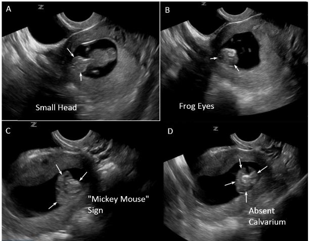 anencephaly ultrasound 9 weeks