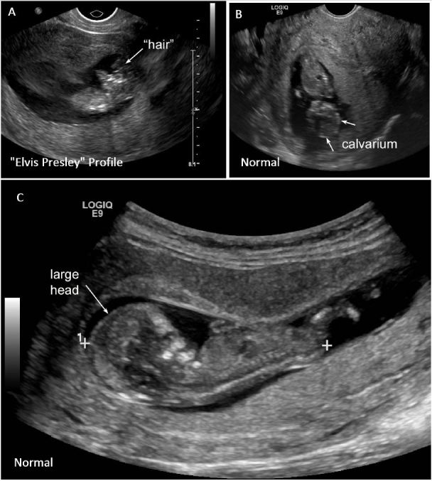 anencephaly ultrasound 9 weeks