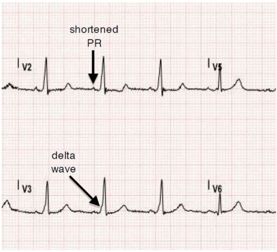 Tachyarrhythmia In Wolff Parkinson White Syndrome The Western Journal