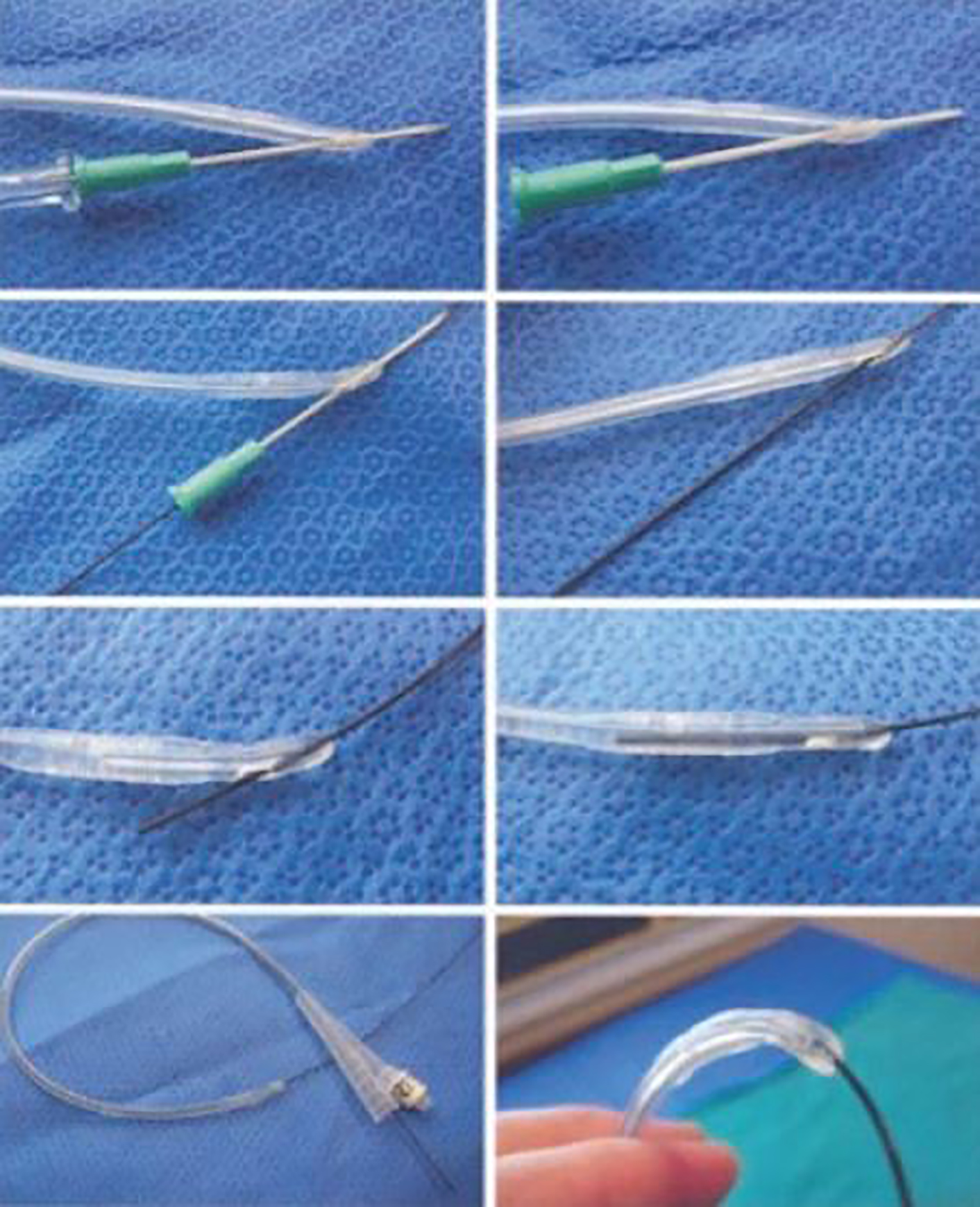 Cureus An Easy Solution For Difficult Urethral Catheter: