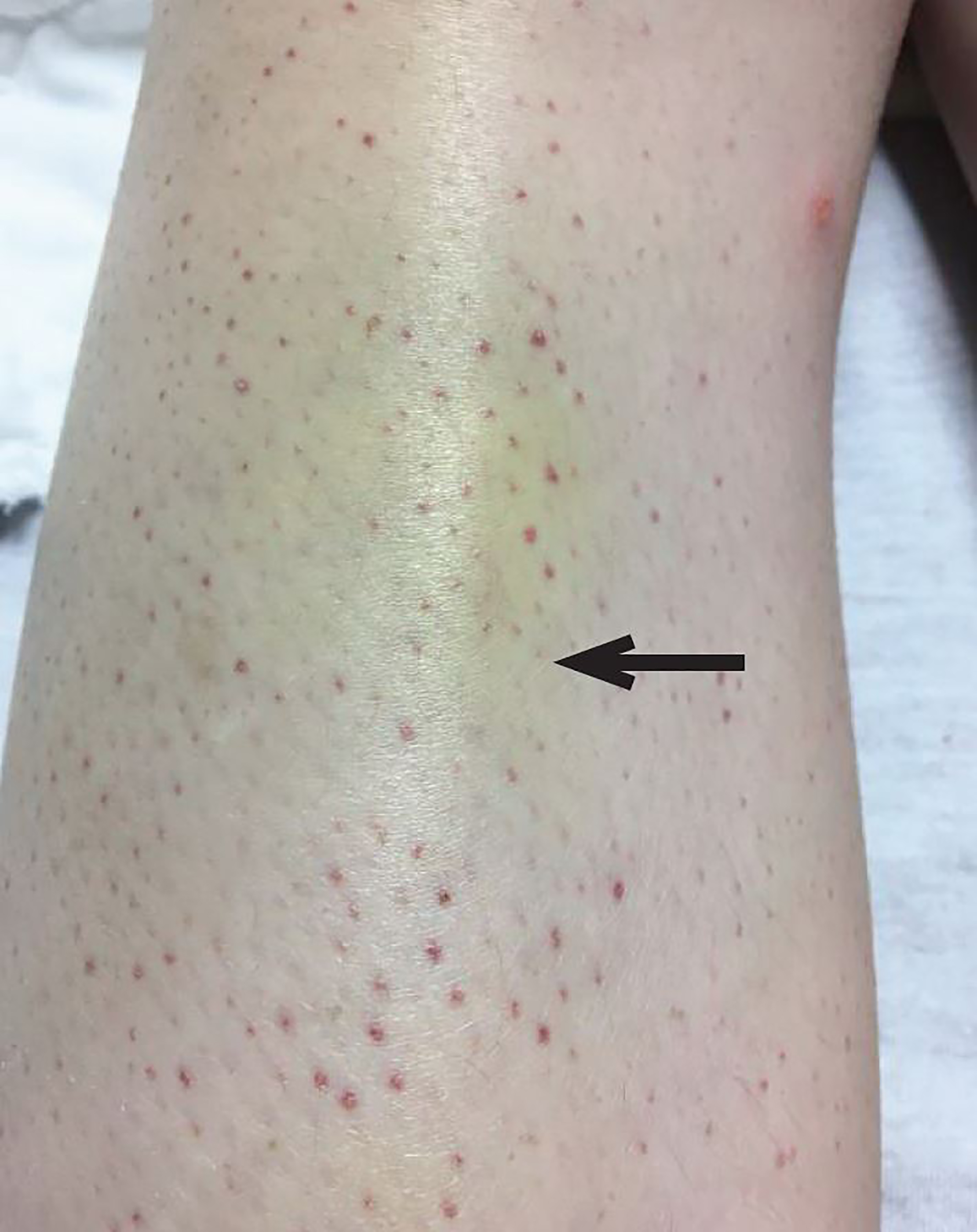 Ecchymosis Vs Petechiae