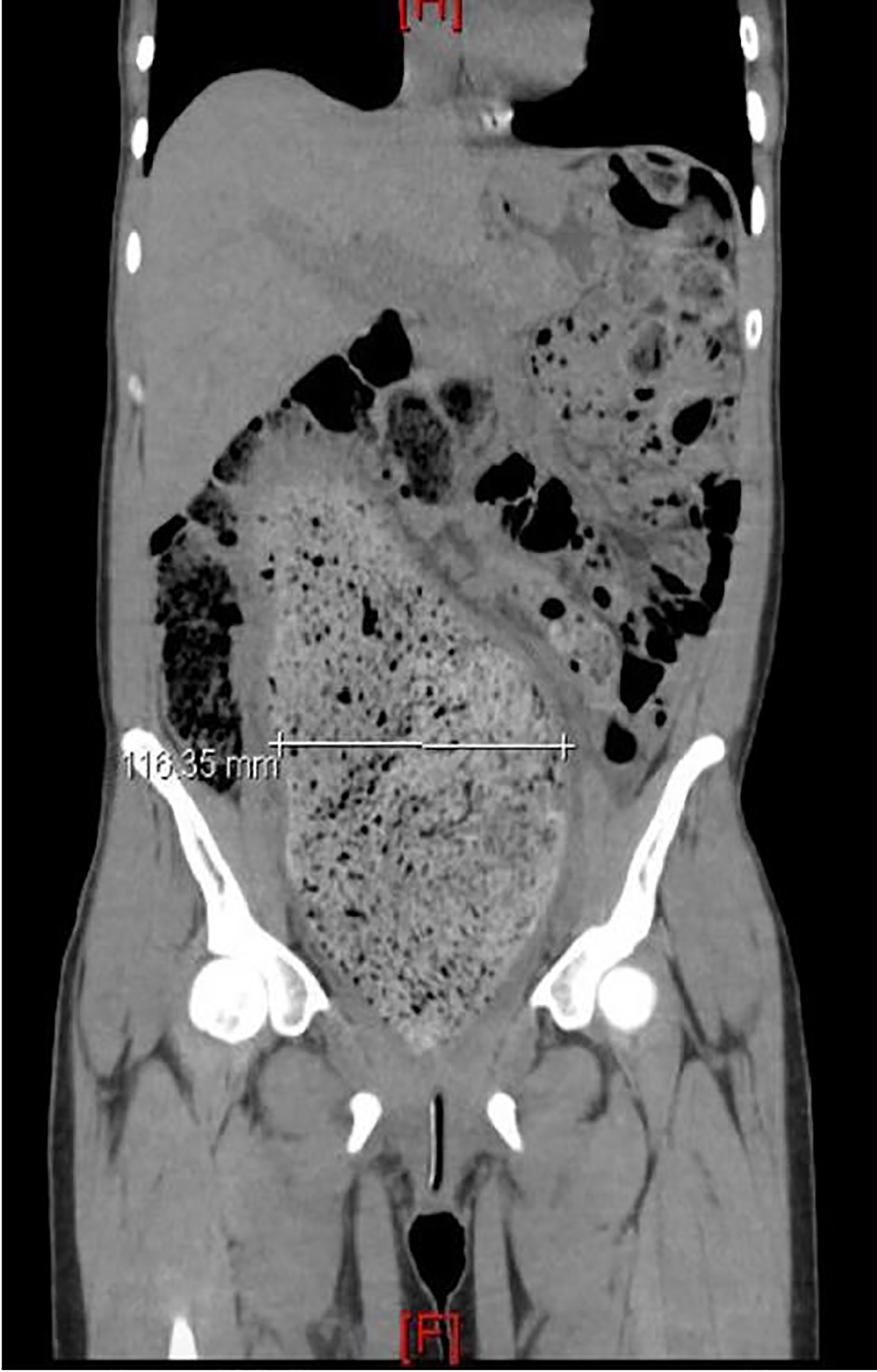 An Unusual of Acute Urinary Retention - The Western Journal of Emergency Medicine