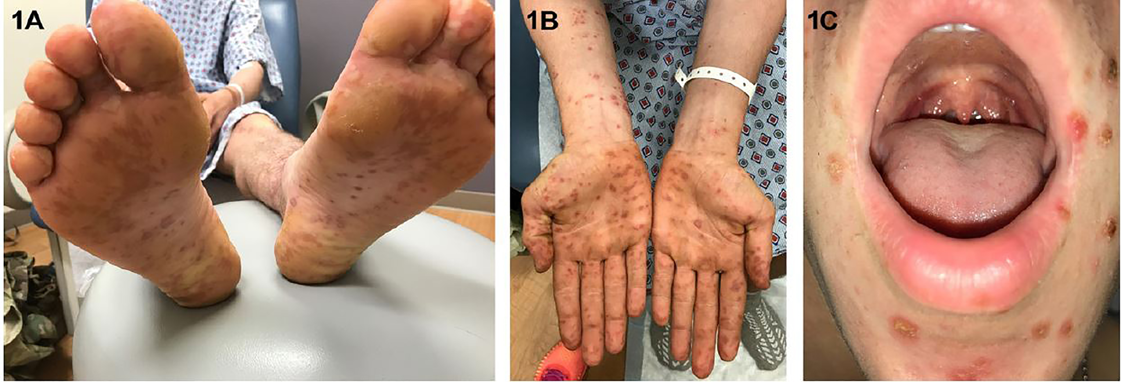 atypical-presentation-of-hand-foot-and-mouth-disease-in-an-adult