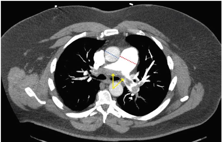 saddle pulmonary embolism xray