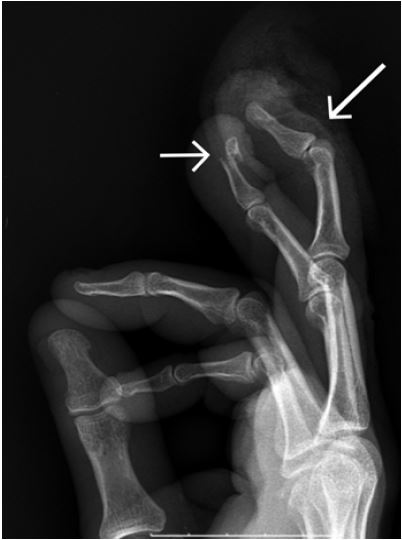 Mallet Fracture X Ray Mallet Finger Litfl Trauma Library A Hand