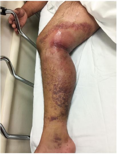 Right calf with swelling and induration of skin at presentation.
