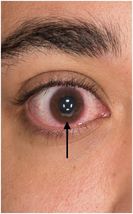 A Cloudy Conical Cornea - The Western Journal of Emergency Medicine