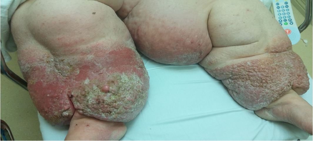 papillomatosis cutis icd