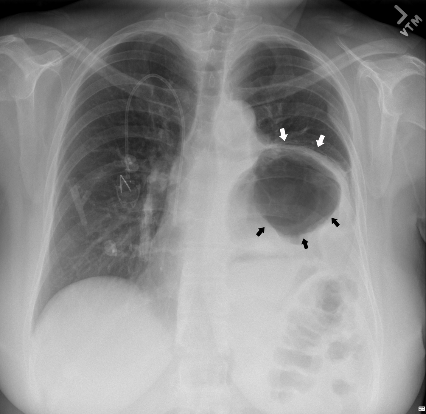 paraesophageal hernia with gastric volvulus