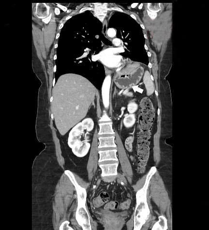 paraesophageal hernia with gastric volvulus