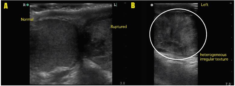 testicular rupture ultrasound