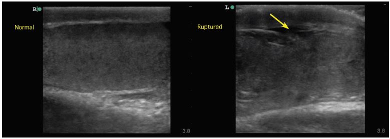 testicular rupture ultrasound