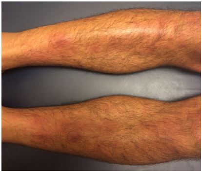 erythema nodosum legs